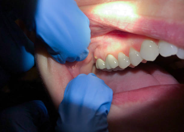 Best Knocked-Out Tooth (Avulsed Tooth) Treatment in South Rosemary, NC